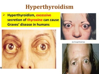  Hyperthyroidism, excessive
secretion of thyroxine can cause
Graves’ disease in humans
Hyperthyroidism
10
 