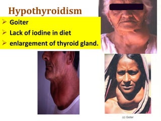 Hypothyroidism
 Goiter
 Lack of iodine in diet
 enlargement of thyroid gland.
 