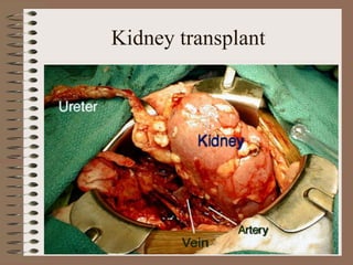 Kidney transplant
 