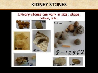 KIDNEY STONES
 