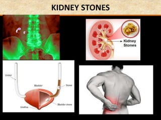 KIDNEY STONES
 