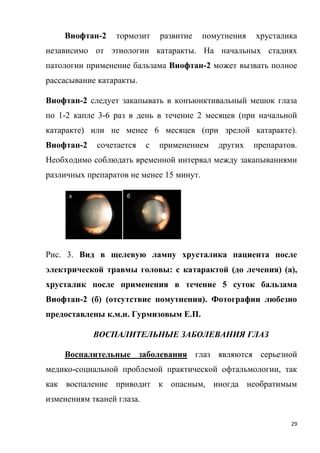29
Виофтан-2 тормозит развитие помутнения хрусталика
независимо от этиологии катаракты. На начальных стадиях
патологии применение бальзама Виофтан-2 может вызвать полное
рассасывание катаракты.
Виофтан-2 следует закапывать в конъюнктивальный мешок глаза
по 1-2 капле 3-6 раз в день в течение 2 месяцев (при начальной
катаракте) или не менее 6 месяцев (при зрелой катаракте).
Виофтан-2 сочетается с применением других препаратов.
Необходимо соблюдать временной интервал между закапываниями
различных препаратов не менее 15 минут.
Рис. 3. Вид в щелевую лампу хрусталика пациента после
электрической травмы головы: с катарактой (до лечения) (а),
хрусталик после применения в течение 5 суток бальзама
Виофтан-2 (б) (отсутствие помутнения). Фотографии любезно
предоставлены к.м.н. Гурмизовым Е.П.
ВОСПАЛИТЕЛЬНЫЕ ЗАБОЛЕВАНИЯ ГЛАЗ
Воспалительные заболевания глаз являются серьезной
медико-социальной проблемой практической офтальмологии, так
как воспаление приводит к опасным, иногда необратимым
изменениям тканей глаза.
а б
 