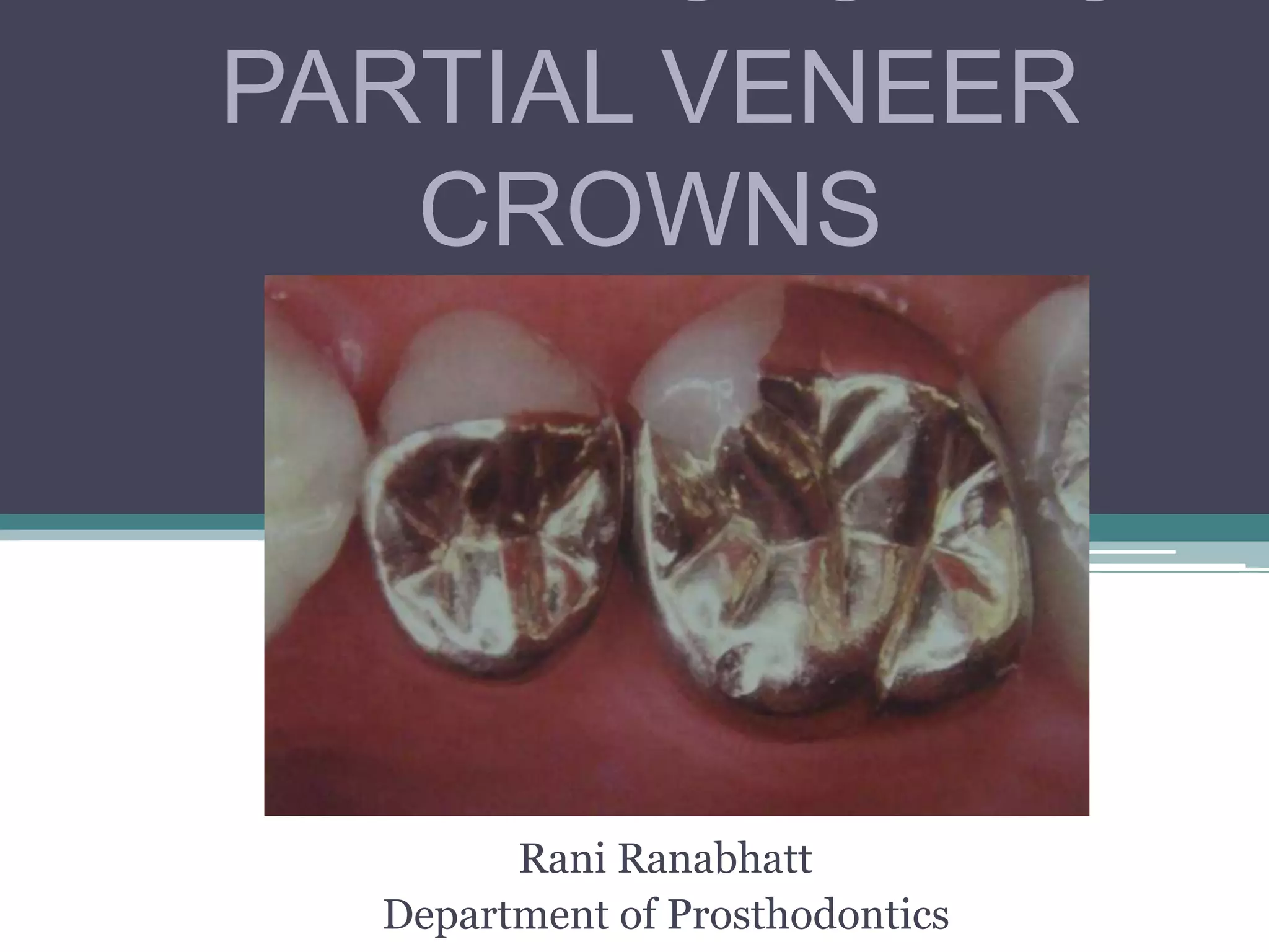 Tooth preparation for partial veneer crwns PPT