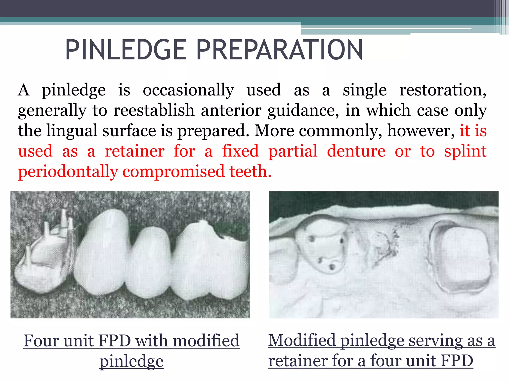 Tooth preparation for partial veneer crwns PPT