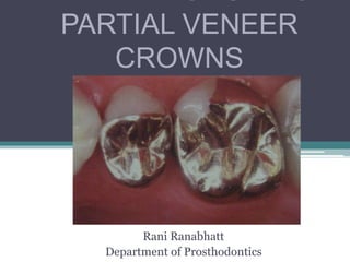 PREPARATIONS FOR
PARTIAL VENEER
CROWNS
Rani Ranabhatt
Department of Prosthodontics
 