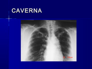 1. radiologia semiologia torax curso | PPT