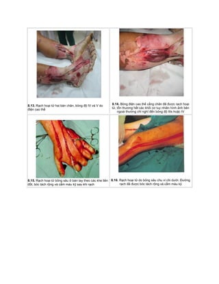 8.13. Rạch hoại tử hai bàn chân, bỏng độ IV và V do
điện cao thế
8.14. Bỏng điện cao thế cẳng chân đã được rạch hoại
tử, tổn thương hết các khối cơ tuy nhiên hình ảnh bên
ngoài thường chỉ nghĩ đến bỏng độ IIIs hoặc IV
8.15. Rạch hoại tử bỏng sâu ở bàn tay theo các khe liên
đốt, bóc tách rộng và cầm máu kỹ sau khi rạch
8.16. Rạch hoại tử do bỏng sâu chu vi chi dưới. Đường
rạch đã được bóc tách rộng và cầm máu kỹ
 
