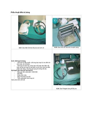 Phẫu thuật điều trị bỏng
8.21. Dao điện Zimmer lấy da các kích cỡ 8.22. Dao khía da mắt lưới chuyên dụng
8.23. Cắt hoại tử bỏng
- Cắt hoại tử tiếp tuyến: cắt từng lớp hoại tử cho đến khi
rớm máu, tới mô lành.
- Cắt hoại tử toàn lớp: dùng dao mổ hoặc dao điện cắt
toàn bộ lớp da hoại tử bao gồm cả tổ chức dưới da đến
phần cân nông. Thường áp dụng khi bỏng rất sâu
Kỹ thuật cầm máu khi cắt hoại tử
- Đắp gạc tẩm adrenalin 1/200 000
- Đốt điện
- Khâu cầm máu
- Đắp Thrombin tại chỗ
- Tiêm adrenalin dưới hoại tử
Garo phía trên chỗ cắt
8.24. Dao Padgett dùng để lấy da
 