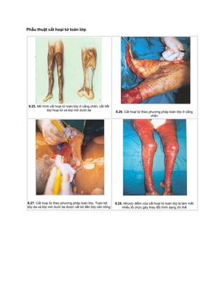 Phẫu thuật cắt hoại tử toàn lớp
8.25. Mô hình cắt hoại tử toàn lớp ở cẳng chân, cắt hết
lớp hoại tử và lớp mỡ dưới da 8.26. Cắt hoại tử theo phương pháp toàn lớp ở cẳng
chân
8.27. Cắt hoại tử theo phương pháp toàn lớp. Toàn bộ
lớp da và lớp mỡ dưới da được cắt bỏ đến lớp cân nông
8.28. Nhược điểm của cắt hoại tử toàn lớp là làm mất
nhiều tổ chức gây thay đổi hình dạng chi thể
 