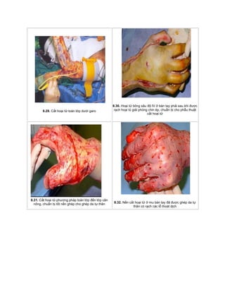8.29. Cắt hoại tử toàn lớp dưới garo
8.30. Hoại tử bỏng sâu độ IV ở bàn tay phải sau khi được
rạch hoại tủ giải phóng chin ép, chuẩn bị cho phẫu thuật
cắt hoại tử
8.31. Cắt hoại tử phương pháp toàn lớp đến lớp cân
nông, chuẩn bị tốt nền ghép cho ghép da tự thân 8.32. Nền cắt hoại tử ở mu bàn tay đã được ghép da tự
thân có rạch các lỗ thoát dịch
 