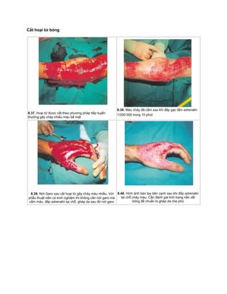 Cắt hoại tử bỏng
8.37. Hoại tử được cắt theo phương pháp tiếp tuyến
thường gây chảy nhiều máu bề mặt
8.38. Máu chảy đã cầm sau khi đắp gạc tẩm adrenalin
1/200 000 trong 10 phút
8.39. Nới Garo sau cắt hoại tử gây chảy máu nhiều. Với
phẫu thuật viên có kinh nghiệm thì không cần nới garo mà
cầm máu, đắp adrenalin tại chỗ, ghép da sau đó nới garo
8.40. Hình ảnh bàn tay bên cạnh sau khi đắp adrenalin
tại chỗ chảy máu. Cần đánh giá tình trạng nền vết
bỏng để chuẩn bị ghép da che phủ
 