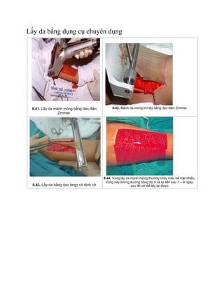 Lấy da bằng dụng cụ chuyên dụng
8.41. Lấy da mảnh mỏng bằng dao điện
Zimmer
8.42. Mảnh da mỏng khi lấy bằng dao điện Zimmer
8.43. Lấy da bằng dao largo có định cỡ
8.44. Vùng lấy da mảnh mỏng thường chảy máu bề mặt nhiều.
Vùng này tương đương bỏng độ II và tự liền sau 7 – 9 ngày,
sau đó có thể lấy lại được
 