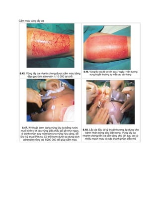 Cầm máu vùng lấy da
8.45. Vùng lấy da nhanh chóng được cầm máu bằng
đắp gạc tẩm adrenalin 1/10 000 tại chỗ
8.46. Vùng lấy da đã tự liền sau 7 ngày. Hiện tượng
xung huyết thường tự mất sau vài tháng
8.47. Kỹ thuật bơm căng vùng lấy da bằng nước
muối sinh lý ở các vùng giải phẫu gồ gề như ngực,
ở bệnh nhân suy mòn làm cho vùng này căng, dễ
lấy (kỹ thuật Pitkin). Có thể bơm dưới da dung dịch
adrenalin nồng độ 1/200 000 để giúp cầm máu
8.48. Lấy da đầu là kỹ thuật thường áp dụng cho
bệnh nhân bỏng sâu diện rộng. Vùng lấy da
nhanh chóng liền và sẵn sàng cho lần sau do có
nhiều mạch máu và các thành phần biểu mô
 