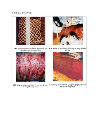 Kỹ thuật ghép da mảnh lưới
8.49. Tạo mảnh da mắt lưới theo tỷ lệ giãn rộng lựa
chọn bằng dụng cụ chuyên dụng
8.50. Mảnh da mắt lưới được căng và ghép lên nền
mô hạt
8.51. Ghép da tự thân mảnh lưới 1:2 trên nền cắt hoại
tử bỏng sâu vùng lưng
8.52. Ghép da mảnh lưới tỷ lệ giãn rộng 1:2 lên mô
hạt đẹp ở cẳng chân
 