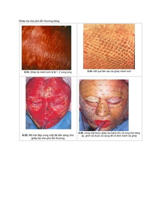 Ghép da che phủ tổn thương bỏng
8.53. Ghép da mảnh lưới tỷ lệ 1: 2 vùng lưng 8.54. Kết quả liền sẹo da ghép mảnh lưới
8.55. Mô hạt đẹp vùng mặt đã sẵn sàng cho
ghép da che phủ tổn thương
8.56. Vùng mặt được ghép da mảnh lớn, là vùng khó băng
ép, ghim da được sử dụng để cố định mảnh da ghép
 