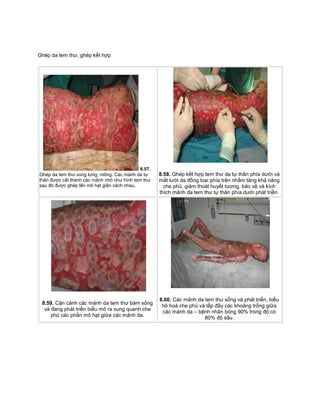 Ghép da tem thư, ghép kết hợp
8.57.
Ghép da tem thư vùng lưng, mông. Các mảnh da tự
thân được cắt thành các mảnh nhỏ như hình tem thư
sau đó được ghép lên mô hạt giãn cách nhau.
8.58. Ghép kết hợp tem thư da tự thân phía dưới và
mắt lưới da đồng loại phía trên nhằm tăng khả năng
che phủ, giảm thoát huyết tương, bảo vệ và kích
thích mảnh da tem thư tự thân phía dưới phát triển
8.59. Cận cảnh các mảnh da tem thư bám sống
và đang phát triển biểu mô ra xung quanh che
phủ các phần mô hạt giữa các mảnh da.
8.60. Các mảnh da tem thư sống và phát triển, biểu
hô hoá che phủ và lấp đầy các khoảng trống giữa
các mảnh da – bệnh nhân bỏng 90% trong đó có
80% độ sâu.
 