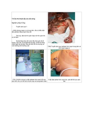 7.9 Các thủ thuật cấp cứu sốc bỏng
Nghiệm pháp 4 ống:
- Truyền dịch qua 1
– nhiều đường ngoại vi và trung tâm, nếu có điều kiện
đặt catheter động mạch theo dõi
- Thở oxy, đặt nội khí quản hoặc mở khí quản khi
có chỉ định
- Sonde foley theo dõi nước tiểu theo giờ về số
lượng, màu sắc, tỷ trọngSonde dạ dày, sonde tá tràng
nhằm giảm áp dạ dày, theo dõi dịch tồn dư dạ dày và
nuôi dưỡng sớm đường ruột
7.10. Truyền dịch qua catheter tĩnh mạch trung tâm và
tĩnh mạch ngoại vi
7.11. Chuẩn bị dụng cụ đặt catheter tĩnh mạch hồi sức
dịch thể, chú ý có đủ các cỡ phù hợp với từng bệnh nhân
7.12. Đặt cathetr tĩnh mạch đùi phải để hồi sức dịch
thể
 