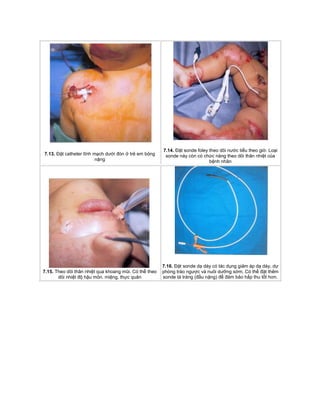 7.13. Đặt catheter tĩnh mạch dưới đòn ở trẻ em bỏng
nặng
7.14. Đặt sonde foley theo dõi nước tiểu theo giờ. Loại
sonde này còn có chức năng theo dõi thân nhiệt của
bệnh nhân
7.15. Theo dõi thân nhiệt qua khoang mũi. Có thể theo
dõi nhiệt độ hậu môn. miệng, thực quản
7.16. Đặt sonde dạ dày có tác dụng giảm áp dạ dày, dự
phòng trào ngược và nuôi dưỡng sớm. Có thể đặt thêm
sonde tá tràng (đầu nặng) để đảm bảo hấp thu tốt hơn.
 
