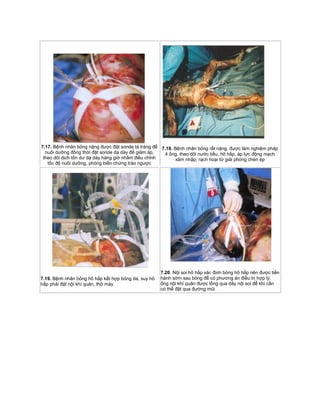 7.17. Bệnh nhân bỏng nặng được đặt sonde tá tràng để
nuôi dưỡng đồng thời đặt sonde dạ dày để giảm áp,
theo dõi dịch tồn dư dạ dày hàng giờ nhằm điều chỉnh
tốc độ nuôi dưỡng, phòng biến chứng trào ngược
7.18. Bệnh nhân bỏng rất nặng, được làm nghiệm pháp
4 ống, theo dõi nước tiểu, hô hấp, áp lực động mạch
xâm nhập, rạch hoại tử giải phóng chèn ép
7.19. Bệnh nhân bỏng hô hấp kết hợp bỏng da, suy hô
hấp phải đặt nội khí quản, thở máy
7.20. Nội soi hô hấp xác định bỏng hô hấp nên được tiến
hành sớm sau bỏng để có phương án điều trị hợp lý.
ống nội khí quản được lồng qua dây nội soi để khi cần
có thể đặt qua đường mũi
 