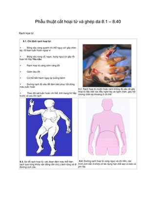 Phẫu thuật cắt hoại tử và ghép da 8.1 – 8.40
Rạch họai tử
8.1. Chỉ định rạch hoại tử:
+ Bỏng sâu vòng quanh chi thể nguy cơ/ gây chèn
ép, rối loạn tuần hoàn ngoại vi
+ Bỏng sâu vùng cổ, ngực, bụng nguy cơ gây rối
loạn hô hấp Yêu cầu:
+ Rạch hoại tử càng sớm càng tốt
+ Giảm đau tốt
+ Có thể tiến hành ngay tại buồng bệnh
+ Đường rạch đủ sâu để đảm bảo phục hồi dòng
máu tuần hoàn
+ Theo dõi sát tuần hoàn chi thể, tình trạng hô hấp
trước và sau khi rạch
8.2. Rạch hoại tử muộn hoặc rạch không đủ sâu sẽ gây
hoại tử đặc biệt các đầu ngón tay và ngón chân, gây hội
chứng chèn ép khoang ở chi thể
8.3. Sơ đồ rạch hoại tử, các đoạn đậm màu thể hiện
rạch qua vùng khớp vận động cần chú ý tách rộng và đi
đường zích zắc.
8.4. Đường rạch hoại tử vùng ngực và chi trên, các
hình zích zắc ở khớp có tác dụng hạn chế sẹo co kéo và
phì đại.
 