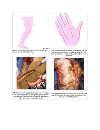8.5. Rạch
hoại tử ở chi dưới, có thể phải rạch qua cân nếu nghi
ngờ hội chứng chèn ép khoang
8.6. Rạch hoại tử bàn tay, đường rạch theo các khe liên
đốt, hai bên các ngón tay, có thể phải giải phóng các
đường hầm Canal và Guyon nếu có dấu hiệu chèn ép
thần kinh
8.7. Rạch hoại tử bỏng sâu ở cẳng chân có thể sử dụng
dao mỏ thường hoặc dao điện. Dùng dao mổ thường
hay gây chảy máu, dùng dao mổ điện dễ gây đau cho
bệnh nhân, do vậy phải giảm đau tốt
8.8. Bỏng sâu vùng ngực bụng gây cản trở hô hấp, rạch
hoại tử vùng ngực tách vùng ngực, bụng và lưng, tạo
điều kiện cho hô hấp dễ dàng
 