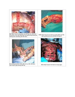 8.9. Rạch hoại tử vùng ngực qua hết lớp da, phần hoại
tử tự tách ra với rất nhiều dịch và huyết tương thoát qua
đường rạch mà không cần bóc tách
8.10. Rạch hoại tử ở chi trên sau bỏng điện cao thế,
rạch qua lớp cân vào các khối cơ hoại tử
8.11. Bỏng sâu độ IV 95% diện tích cơ thể, đã được
rạch hoại tử giải phóng chèn ép
8.12. Rạch hoại tử hình bàn cờ vùng ngực
 