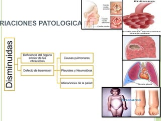 RIACIONES PATOLOGICAS
Disminuidas
Deficiencia del órgano
emisor de las
vibraciones
Defecto de trasmisión
Causas pulmonares
Pleurales y Neumotórax
Alteraciones de la pared
 