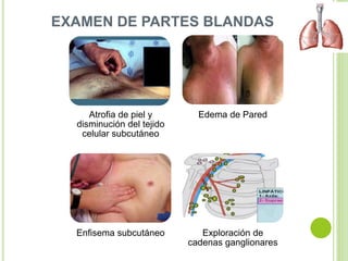 EXAMEN DE PARTES BLANDAS
Atrofia de piel y
disminución del tejido
celular subcutáneo
Edema de Pared
Enfisema subcutáneo Exploración de
cadenas ganglionares
 