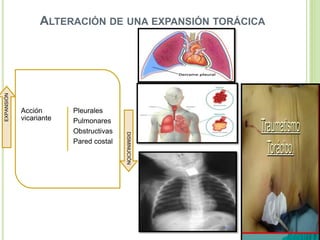 ALTERACIÓN DE UNA EXPANSIÓN TORÁCICA
Acción
vicariante
Pleurales
Pulmonares
Obstructivas
Pared costal
EXPANSIÓN
DISMINUCIÓN
 