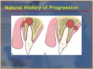 Copyright 2003, Elsevier Science (USA). All rights reserved.
Natural History of Progression
 