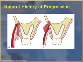Copyright 2003, Elsevier Science (USA). All rights reserved.
Natural History of Progression
 