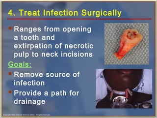 Copyright 2003, Elsevier Science (USA). All rights reserved.
4. Treat Infection Surgically
 Ranges from opening
a tooth and
extirpation of necrotic
pulp to neck incisions
Goals:
 Remove source of
infection
 Provide a path for
drainage
 