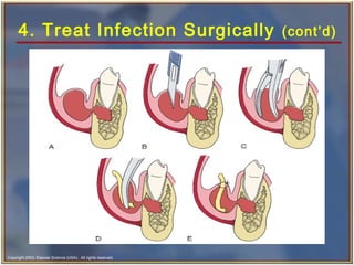 Copyright 2003, Elsevier Science (USA). All rights reserved.
4. Treat Infection Surgically (cont’d)
 
