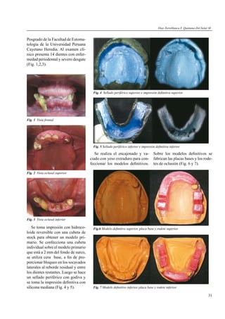 31
Posgrado de la Facultad de Estoma-
tología de la Universidad Peruana
Cayetano Heredia. Al examen clí-
nico presenta 14 dientes con enfer-
medad periodontal y severo desgate
(Fig. 1,2,3).
Fig. 1 Vista frontal
Fig. 4 Sellado periférico superior e impresión deﬁnitiva superior
Fig. 5 Sellado periférico inferior e impresión deﬁnitiva inferior
Fig. 2 Vista oclusal superior
Fig. 3 Vista oclusal inferior
Se toma impresión con hidroco-
loide reversible con una cubeta de
stock para obtener un modelo pri-
mario. Se confecciona una cubeta
individual sobre el modelo primario
que está a 2 mm del fondo de surco,
se utiliza cera base, a ﬁn de pro-
porcionar bloqueo en los socavados
laterales al reborde residual y entre
los dientes restantes. Luego se hace
un sellado periférico con godiva y
se toma la impresión deﬁnitiva con
silicona mediana (Fig. 4 y 5).
Se realiza el encajonado y va-
ciado con yeso extraduro para con-
feccionar los modelos deﬁnitivos.
Fig.6 Modelo deﬁnitivo superior, placa base y rodete superior
Sobre los modelos deﬁnitivos se
fabrican las placas bases y los rode-
tes de oclusión (Fig. 6 y 7).
Díaz-Torreblanca F, Quintana-Del.Solar M .
Fig. 7 Modelo deﬁnitivo inferior, placa base y rodete inferior
 