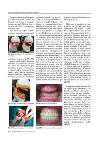 32 Rev. Estomatol Herediana. 2013 Ener-Mar;23(1)
Fig. 11 Maxilares post-exodoncia
Fig. 12 Prótesis total inmediata instalada
en relación céntrica (Fig. 8A y 8B).
Luego, en el modelo deﬁnitivo,
se simula la extracción y remode-
lado óseo. Se construye una guía
quirúrgica, la cual se utilizará en
el momento de la extracción de los
dientes, reduciendo la eliminación
de hueso en exceso y mejorando la
comodidad, retención y estabilidad
de la futura prótesis (Fig. 9 y 10).
En los modelos remodelados se
realiza el enﬁlado de dientes poli-
planos y se procesa con acrílico ro-
sado de termocurado para confec-
cionar la prótesis total. El día que se
realiza en el paciente la exodoncia
y remodelado óseo se cuenta con
las prótesis totales confeccionadas.
Al momento de su instalación se
evalúa con cuidado la oclusión en
relación céntrica y posiciones ex-
céntricas. Se hacen las correcciones
intrabucales y se realiza un reba-
sado con acondicionador de tejidos
para compensar la discrepancia en
el ajuste, garantizando la comodi-
dad del paciente, la estabilidad y la
retención. Se le indica al paciente
que debe de usar la prótesis por 24
horas, esto es para que ocurra la
cicatrización de acuerdo a la for-
ma de la base de la dentadura. El
mantenimiento de la prótesis debe
ser explicada con minuciosidad y
detenimiento, entregando de prefe-
rencia las indicaciones por escrito.
Se le indica al paciente que coma ali-
mentos blandos pero nutritivos y que
regrese al siguiente día para su con-
trol (Fig. 11 y 12).
Hasta que se complete la cica-
trización, la cavidad bucal debe
conservarse muy limpia. La pró-
tesis debe retirarse cuatro a cinco
veces al día, enjuagandose la boca
de manera minuciosa. Las áreas de
soporte de las dentaduras, más que
los sitios recientes de extracción, se
deben cepillar con un cepillo den-
tal blando o con una gasa húmeda
pasada alrededor de los dedos. La
lengua también se debe cepillar
muy bien. Las prótesis se deben uti-
lizar en la noche, los primeros tres
a cuatro días solamente. Después
de este periodo, se deben retirar en
la noche. Es necesario evitar los
enjuagues bucales que contengan
alcohol, durante los primeros 10 a
14 días, o hasta que se epitelicen
las áreas de extracción. La dieta del
paciente debe ser blanda, alimentos
fáciles de masticar, hasta que pue-
da morder con sus prótesis de ma-
nera cómoda. Haciendo énfasis en
la necesidad de una dieta nutritiva
(10,11).
Las prótesis deben limpiarse con
un cepillo para dentaduras y un
líquido no abrasivo, detergente o
jabón. No hay que usar pasta den-
tal ni limpiadores abrasivos. Las
prótesis se sumergen en un limpia-
dor durante 30 minutos al día, los
primeros tres a cuatro días, y des-
pués durante las noches. Siempre
deberan colocarse en agua o en un
limpiador de dentaduras, cuando no
esté en boca. Se le debe informar
al paciente acerca de los problemas
frecuentes durante la experiencia
inicial de la prótesis, que incluyen
molestia, salivación excesiva, diﬁ-
cultad en la alimentación y habla
(12,13).
Prótesis Total inmediata como alternativa de tratamiento.
Luego se llevan las placas bases
y rodetes de oclusión a la boca del
paciente y se obtiene la misma di-
mensión vertical (DV) que tiene el
paciente antes de la extracción y re-
modelado óseo.
Se montan los modelos deﬁniti-
vos en un articulador semiajustable
Fig. 8A y 8B. Montaje de modelos sin re-
modelado.
A B
Fig. 9 Modelo con remodelado en articulador
Fig. 10 Fase quirúrgica del remodelado
 