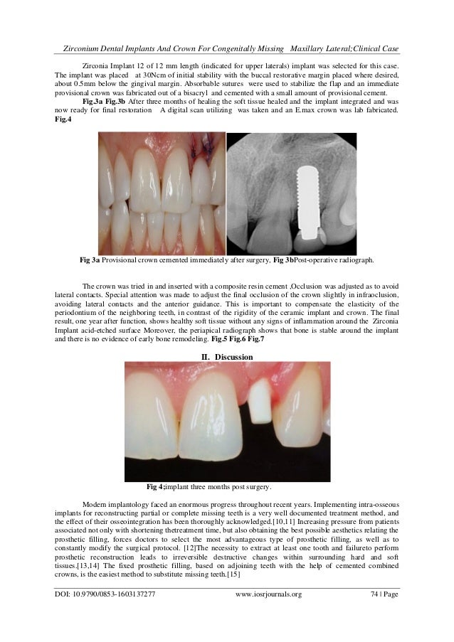 Zirconium Dental Implants And Crown for Congenitally Missing Maxillar…
