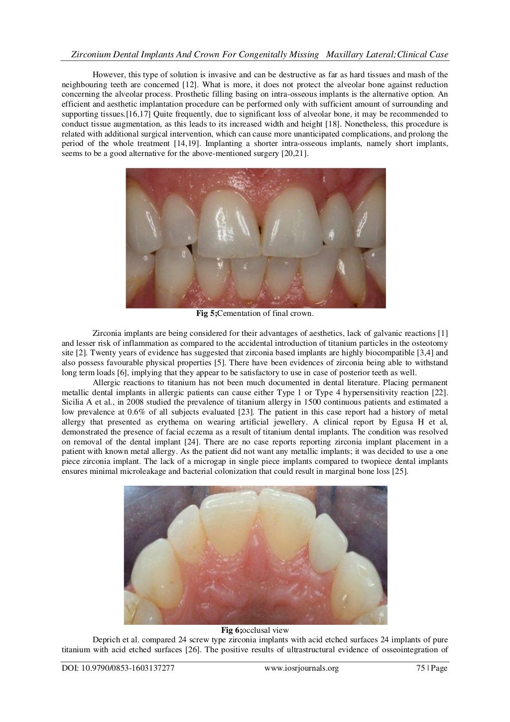 Zirconium Dental Implants And Crown for Congenitally Missing Maxillar…