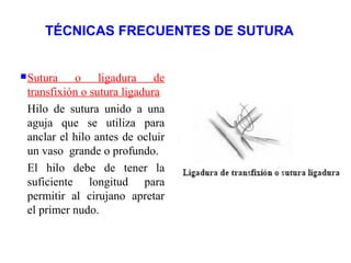 TÉCNICAS FRECUENTES DE SUTURA
Sutura o ligadura de
transfixión o sutura ligadura.
Hilo de sutura unido a una
aguja que se utiliza para
anclar el hilo antes de ocluir
un vaso grande o profundo.
El hilo debe de tener la
suficiente longitud para
permitir al cirujano apretar
el primer nudo.
 