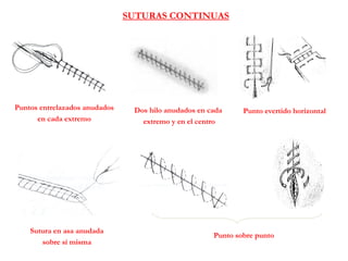 Punto sobre punto
SUTURAS CONTINUAS
Punto evertido horizontal
Sutura en asa anudada
sobre sí misma
Puntos entrelazados anudados
en cada extremo
Dos hilo anudados en cada
extremo y en el centro
 