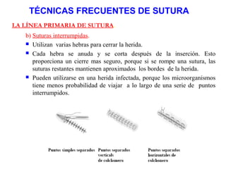 TÉCNICAS FRECUENTES DE SUTURA
LA LÍNEA PRIMARIA DE SUTURA.
b) Suturas interrumpidas.
 Utilizan varias hebras para cerrar la herida.
 Cada hebra se anuda y se corta después de la inserción. Esto
proporciona un cierre mas seguro, porque si se rompe una sutura, las
suturas restantes mantienen aproximados los bordes de la herida.
 Pueden utilizarse en una herida infectada, porque los microorganismos
tiene menos probabilidad de viajar a lo largo de una serie de puntos
interrumpidos.
 
