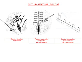 Puntos simples
separados
SUTURAS INTERRUMPIDAS
Puntos separados
verticales
de colchonero
Puntos separados
horizontales
de colchonero
 