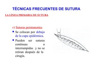 TÉCNICAS FRECUENTES DE SUTURA
LA LÍNEA PRIMARIA DE SUTURA.
c) Suturas permanentes.
 Se colocan por debajo
de la capa epidérmica.
 Pueden ser suturas
continuas o
interrumpidas y no se
retiran después de la
cirugía.
 