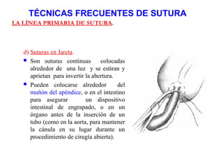 TÉCNICAS FRECUENTES DE SUTURA
LA LÍNEA PRIMARIA DE SUTURA.
d) Suturas en Jareta.
 Son suturas continuas colocadas
alrededor de una luz y se estiran y
aprietan para invertir la abertura.
 Pueden colocarse alrededor del
muñón del apéndice, o en el intestino
para asegurar un dispositivo
intestinal de engrapado, o en un
órgano antes de la inserción de un
tubo (como en la aorta, para mantener
la cánula en su lugar durante un
procedimiento de cirugía abierta).
 