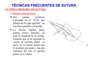 TÉCNICAS FRECUENTES DE SUTURA
LA LÍNEA PRIMARIA DE SUTURA.
e) Suturas subcuticulares.
 Son suturas continuas
colocadas en el TCSC por
debajo de la capa epitelial, en
una línea paralela a la herida.
 La técnica implica pasar
puntos cortos, laterales, en
toda la longitud de la herida.
Después que se ha apretado la
sutura, el extremo distal se
ancla en la misma forma que
el extremo proximal, y los dos
extremos del hilo se anudan
juntos en el centro.
 