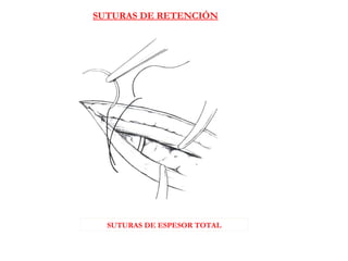 SUTURAS DE ESPESOR TOTAL
SUTURAS DE RETENCIÓN
 
