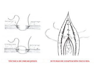 SUTURAS DE COAPTACIÓN INCLUIDA
SUTURAS DE RETENCIÓN
TÉCNICA DE SMEAD JONES
 