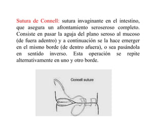 Sutura de Connell: sutura invaginante en el intestino,
que asegura un afrontamiento seroseroso completo.
Consiste en pasar la aguja del plano seroso al mucoso
(de fuera adentro) y a continuación se la hace emerger
en el mismo borde (de dentro afuera), o sea pasándola
en sentido inverso. Esta operación se repite
alternativamente en uno y otro borde.
 