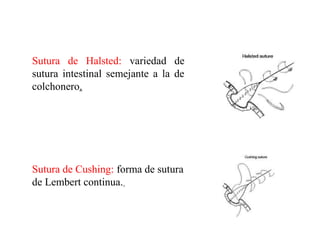 Sutura de Halsted: variedad de
sutura intestinal semejante a la de
colchonero.
Sutura de Cushing: forma de sutura
de Lembert continua.
 
