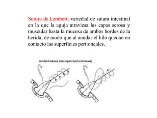 Sutura de Lembert: variedad de sutura intestinal
en la que la aguja atraviesa las capas serosa y
muscular hasta la mucosa de ambos bordes de la
herida, de modo que al anudar el hilo quedan en
contacto las superficies peritoneales.
 
