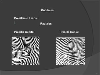 Cubitales
Presillas o Lazos
 Radiales
Presilla Cubital Presilla Radial
27
.
 